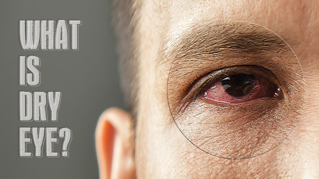 What-is-Dry-Eye